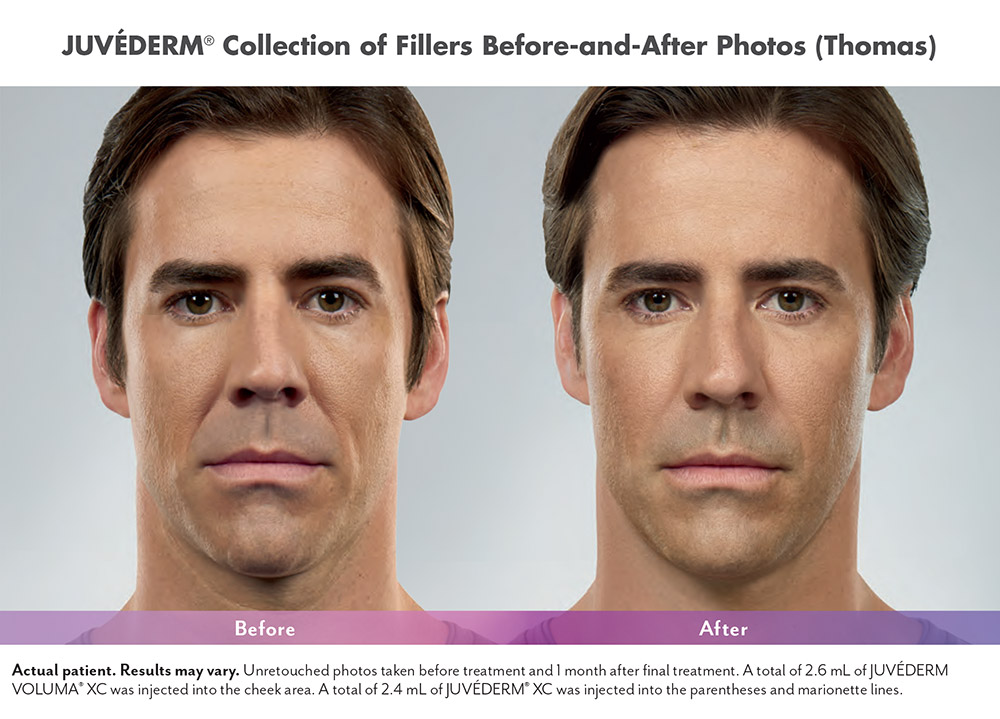 juvederm male before and after