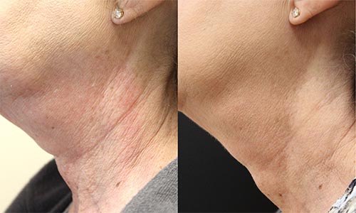 skin rejuvenation before and after